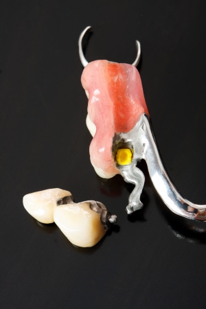 Part of a scheletal prosthesis that replaces missing teeth through special clamping systems and it can be removed by the pacient - part of a series.の写真素材
