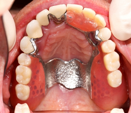 A dental prosthesis for upper denture in mouth.