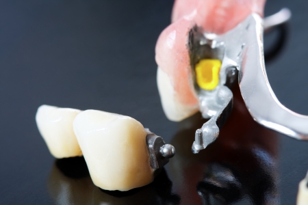 Part of a skeletal prosthesis that replaces missing teeth through special clamping systems and it can be removed by the patient - part of a series.の写真素材