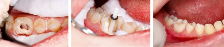 The aesthetic restoration of a lower molar tooth with composite resin, strengthened with fiber glass post.の写真素材