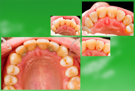 Before and after dental treatment, dental pulp sealing.の写真素材