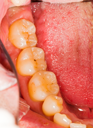 Natural healthy denture of a patient - molars.の写真素材