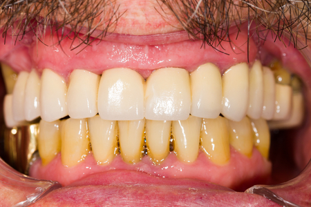 Entire upper dental teeth bridge in patient's mouth.の写真素材