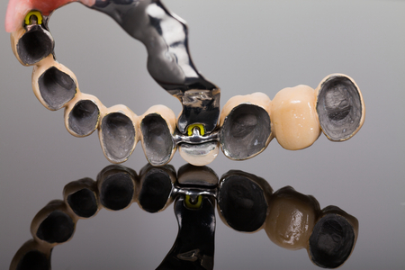 Skeletal prosthesis close-up made by dental technician and dentist. A low cost, but stable dental rehabilitation technique.の写真素材