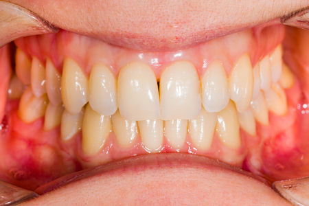 Healthy human denture made with special photography technique in dentist office.の写真素材