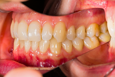 Healthy human denture made with special photography technique in dentist office.の写真素材