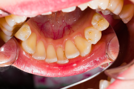 Healthy human denture with minor health issues made with special photography technique in dentist office.の写真素材