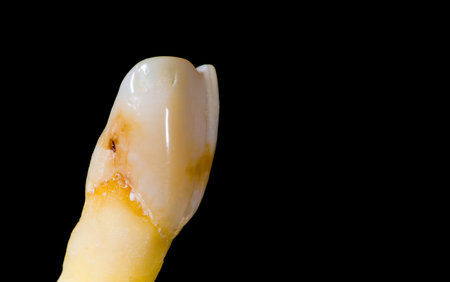 Removed and worn central incisor tooth isolated on black.の写真素材