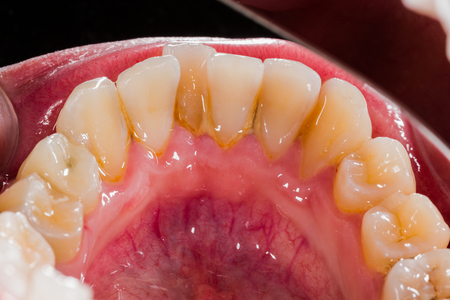 Tartar and plaque on the incisors of the lower jaw.の写真素材