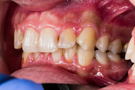 Dental problems closeup for patient education.の写真素材
