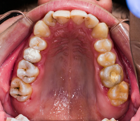 Occlusal view of human teeth - diagnostic of problematic teeth on the upper jaw.の写真素材