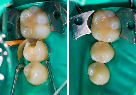 Two treated teeth with composite dental filling, one with high end technique, nanohybrid and the other a standard technique microhybrid.の写真素材