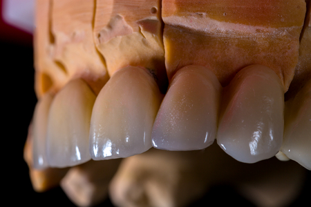 Natural looking ceramnic bridge on gypsum casting.の写真素材