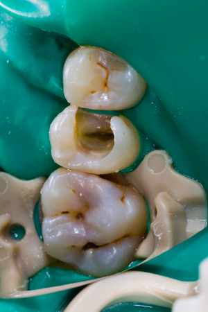 Premolar root canal treatment with rubber dam isolation.の写真素材