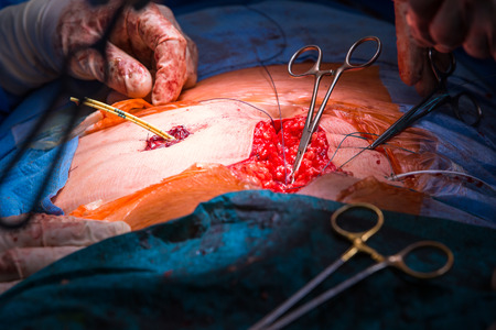 Surgery in a modern hospital being performed by a team of professionals の写真素材