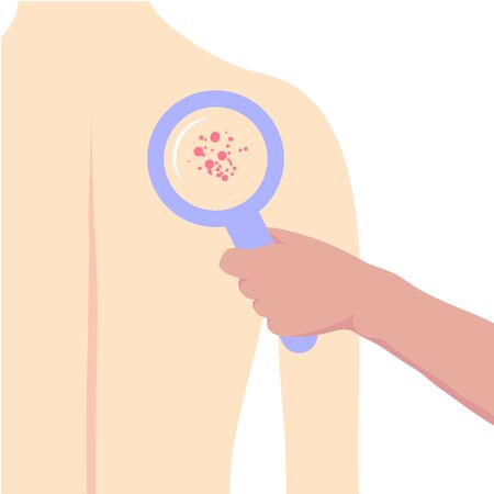 A dermatologist examines a patients skin with a magnifying glass. Dermatological diseases. Banner templateのイラスト素材