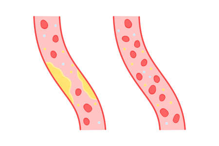 color blood vessels with cholesterol and healthyのイラスト素材