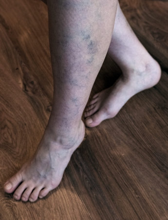 Legs with varicose veins. Vascular disease.