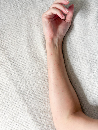 Allergic reaction on the hand. Vertical photo.の写真素材