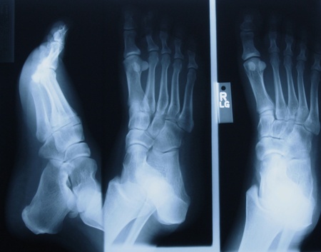 Rt Foot 3vの写真素材