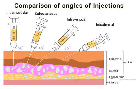 Vector of comparison of angles of injections. Illustration of injection syringe on the skin layers. Types of injections demonstration such as intramuscular, subcutaneous, intravenous, and intradermal.のイラスト素材