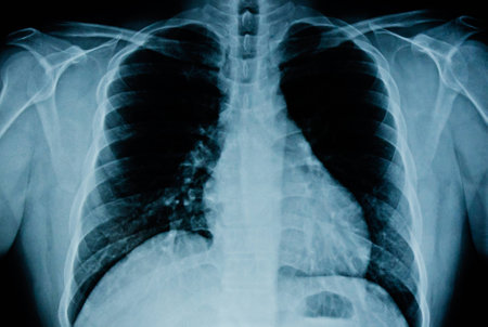 Upright chest x-ray film image of man