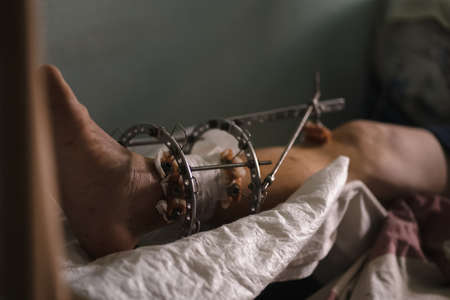 Patient with Ilizarov apparatus fixation after orthopedic surgery. Limb-sparing technique treat complex open bone fractures. Potentially inappropriate material. City Hospital, May 2020, Kyiv, Ukraine.のeditorial素材