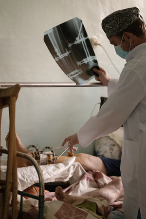Male doctor checking on patient with Ilizarov apparatus fixation after orthopedic surgery holds x-ray. Limb-sparing technique treat complex open bone fractures. City Hospital, May 2020, Kyiv, Ukraine.のeditorial素材