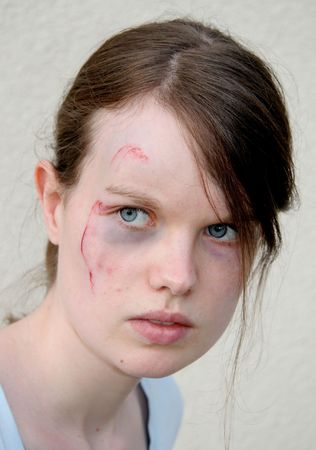 A young woman with a wound on her cheek looking sideways. Victim of domestic violence?の写真素材