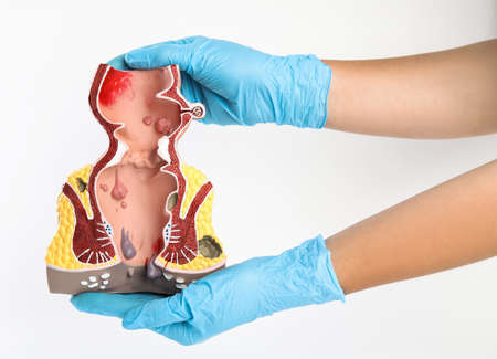 Proctologist holding anatomical model of rectum with hemorrhoids isolated on white, closeupの写真素材