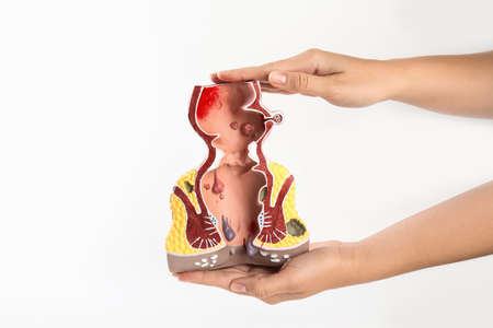 Proctologist holding anatomical model of rectum with hemorrhoids isolated on white, closeup