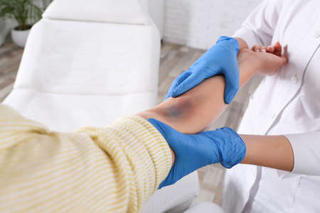 Doctor checking woman's elbow with bruise at hospital, closeupの写真素材