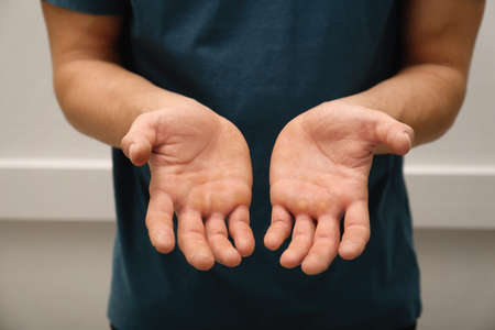 Man suffering from calluses on hands indoors, closeupの写真素材
