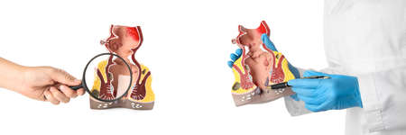 Doctors demonstrating anatomical models of rectum with hemorrhoids on white background, closeup....
