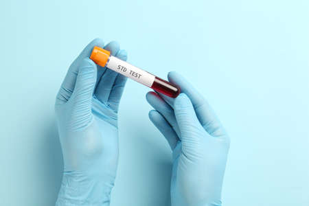 Scientist holding tube with blood sample and label STD Test on light blue background, top viewの写真素材