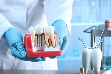 Dentist holding educational model of gum with dental implant between teeth indoors, closeupの写真素材
