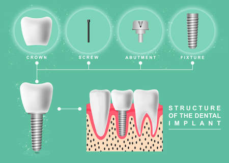 Structure of dental implant on light green background, illustration. educational poster