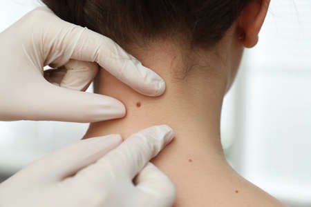 Dermatologist examining patient's birthmark in clinic, closeup viewの写真素材