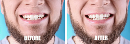 Young man before and after gingivoplasty procedure on light blue background, closeup. banner design