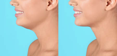 double chin problem. Collage with photos of young woman before and after plastic surgery procedure on turquoise background, closeupの写真素材