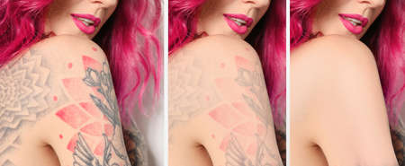 Woman before and after laser tattoo removal procedures, closeup. Collage with photos, banner designの写真素材