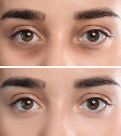 Collage with photos of tired woman with dark circle under eye and after rest, closeupの写真素材