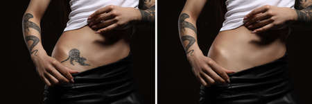 Woman before and after laser tattoo removal procedure on black background, closeup. Collage with photos, banner designの写真素材