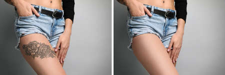 Woman before and after laser tattoo removal procedure on light gray background, closeup. Collage with photos, banner designの写真素材