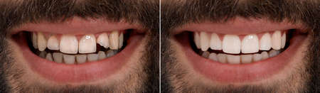 Collage with photos of young man before and after dental treatment, closeup. banner designの写真素材