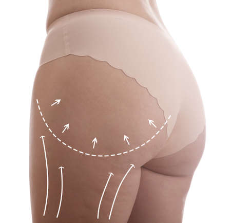 Woman with marks on body before cosmetic surgery operation on white background, closeup