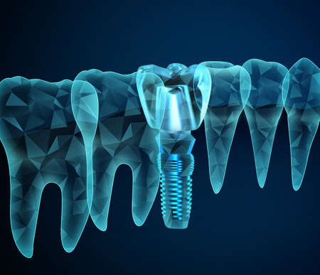 Illustration of teeth and dental implant on dark blue background