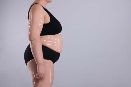 Woman with marks on body before cosmetic surgery operation on light gray background, closeup. Space for textの写真素材