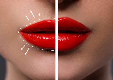 Collage with photos of young woman before and after lips augmentation procedure, closeup