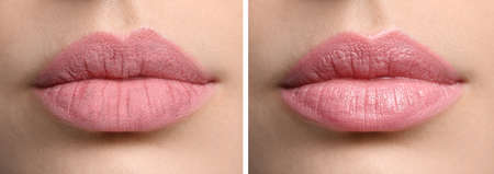 Collage with photos of woman with dry and moisturized lips, closeup. banner designの写真素材